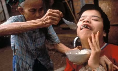 Millions of children were born with deformities, suffering from diseases and living in impoverished conditions. (Credit: vtc.vn)