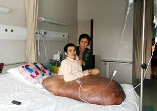 Nguyen Duy Hai and his mother before the surgery.