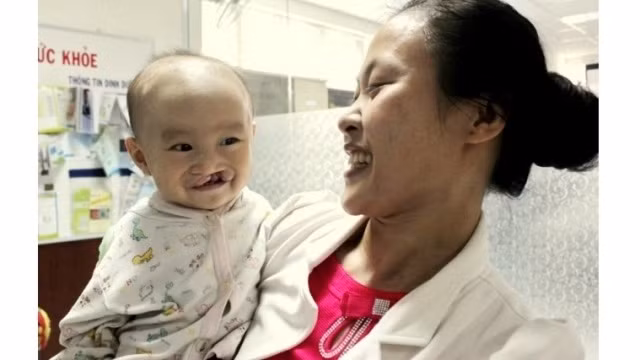 Around 300 children with cleft lips and palates will receive free surgery under the Operation Smile’s programme next month.