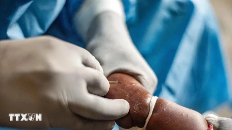 Medical workers treat a patient with monkeypox in Goma, Democratic Republic of Congo, August 15, 2024. (Photo: Xinhua/VNA)