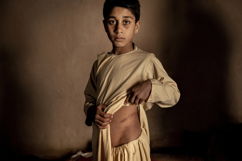 Khalil Ahmad (15)’s kidney was sold to support his family. His Unable to afford food for the family, so in a desperate attempt to save the family, they decided to sell their eldest son's left kidney. (Source: World Press Photo)