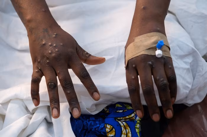 The number of mpox cases reported in Africa so far this year has surpassed 69,000, with the death toll rising to more than 1,260, Africa Centers for Disease Control and Prevention (Africa CDC) has reported.